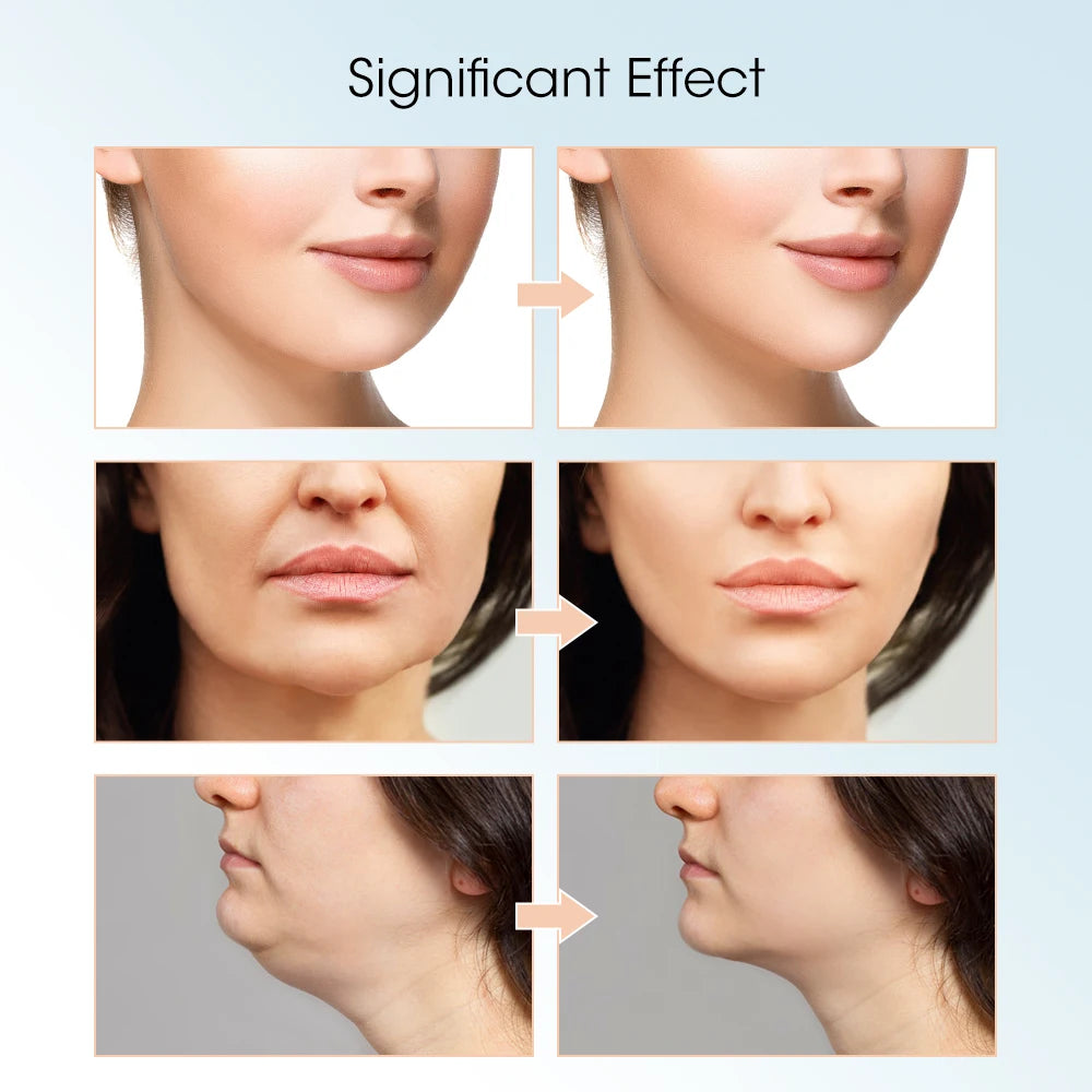 Appareil de lifting du visage par microcourant EMS, rajeunissement de la peau par lumière rouge, masseur facial en V, lifting du double menton, instrument de beauté du visage